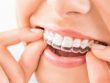 What's New In Dental Braces